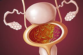 Βακτηριακή κυστίτιδα σε μια γυναίκα